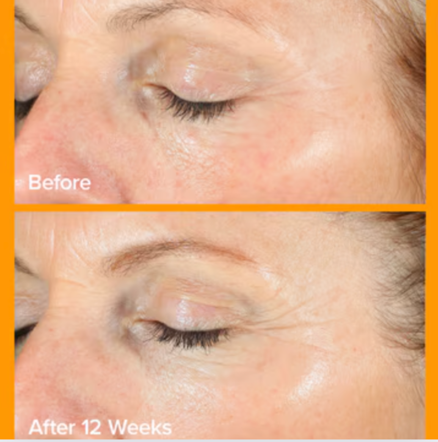 before and after using serum for 12 weeks